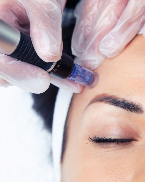 Cover for Microneedling in Glendale CA: Benefits, Results, and Who It Is Best For