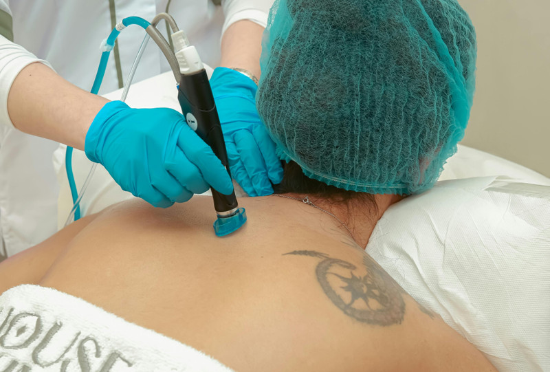 Advanced PicoWay Tattoo Removal in Glendale at Fix Med Spa
