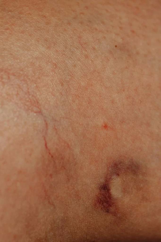 Professional Vascular Lesion Treatment in Glendale at Fix Med Spa