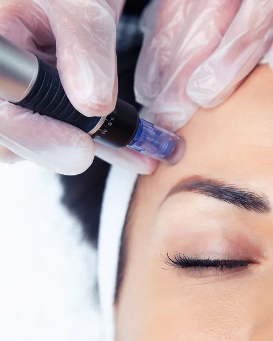Cover for Microneedling in Glendale CA: Benefits, Results, and Who It Is Best For